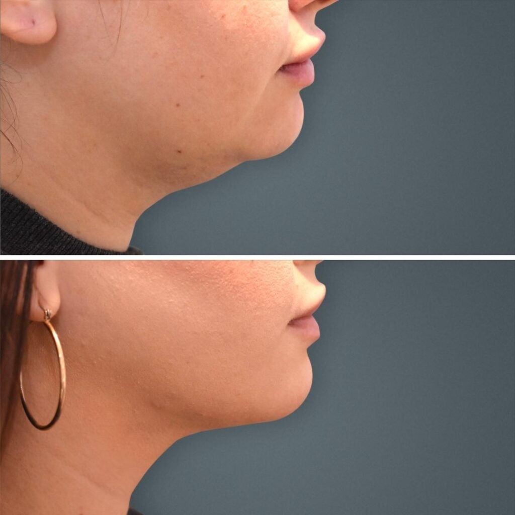 Goldcoast Liposuction Face Female 2023 Left 194 Before And After