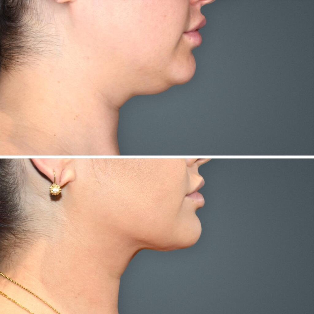 Goldcoast Liposuction Face Female 2023 Left 208 Before And After
