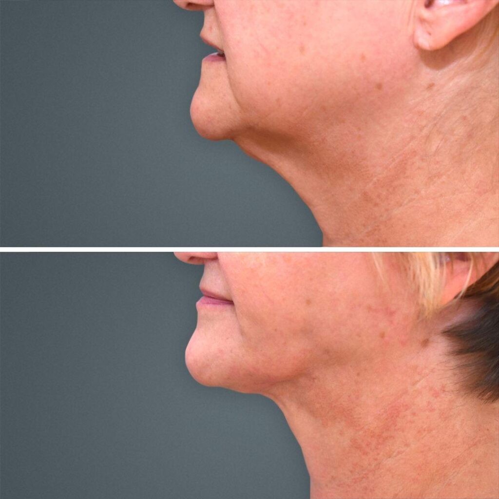 Goldcoast Liposuction Face Female 2023 Right 181 Before And After