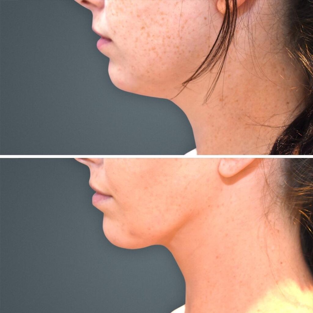 Goldcoast Liposuction Face Female 2023 Right 190 Before And After