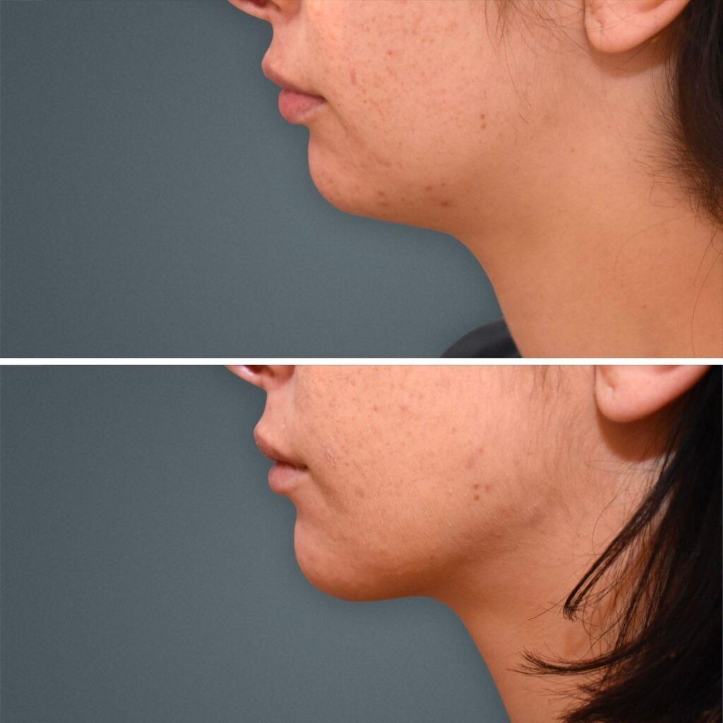 Goldcoast Liposuction Face Female 2023 Right 198 Before And After
