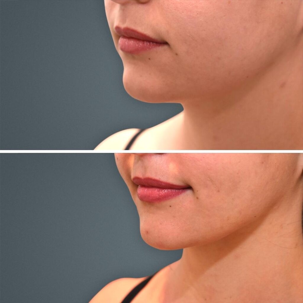 Goldcoast Liposuction Face Female 2023 Right 199 Before And After
