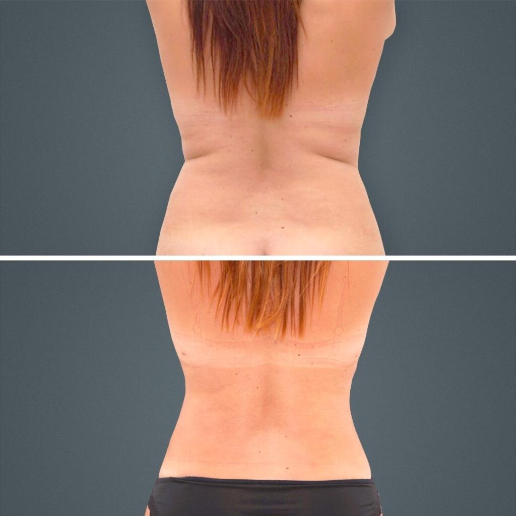 Goldcoast Liposuction Lovehandles Female 2023 Rear 136 Before And After
