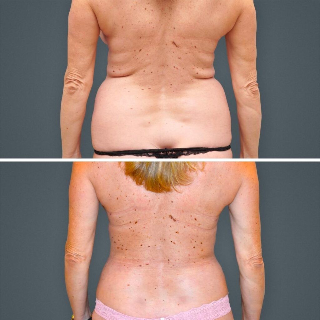 Goldcoast Liposuction Lovehandles Female 2023 Rear 151 Before And After