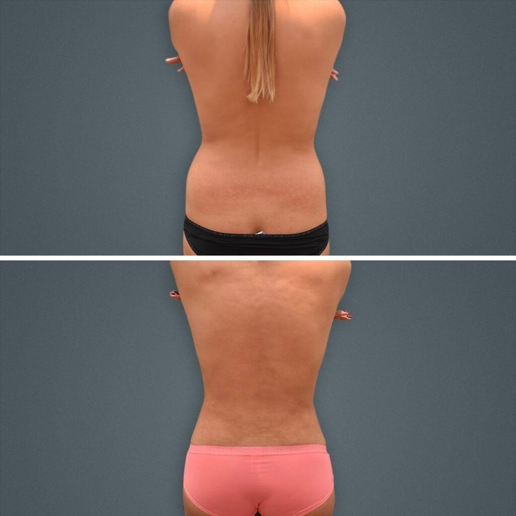 Goldcoast Liposuction Lovehandles Female 2023 Rear 160 Before And After