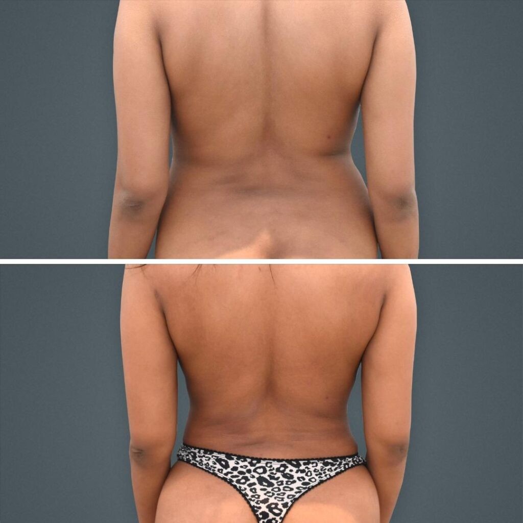 Goldcoast Liposuction Lovehandles Female 2023 Rear 170 Before And After