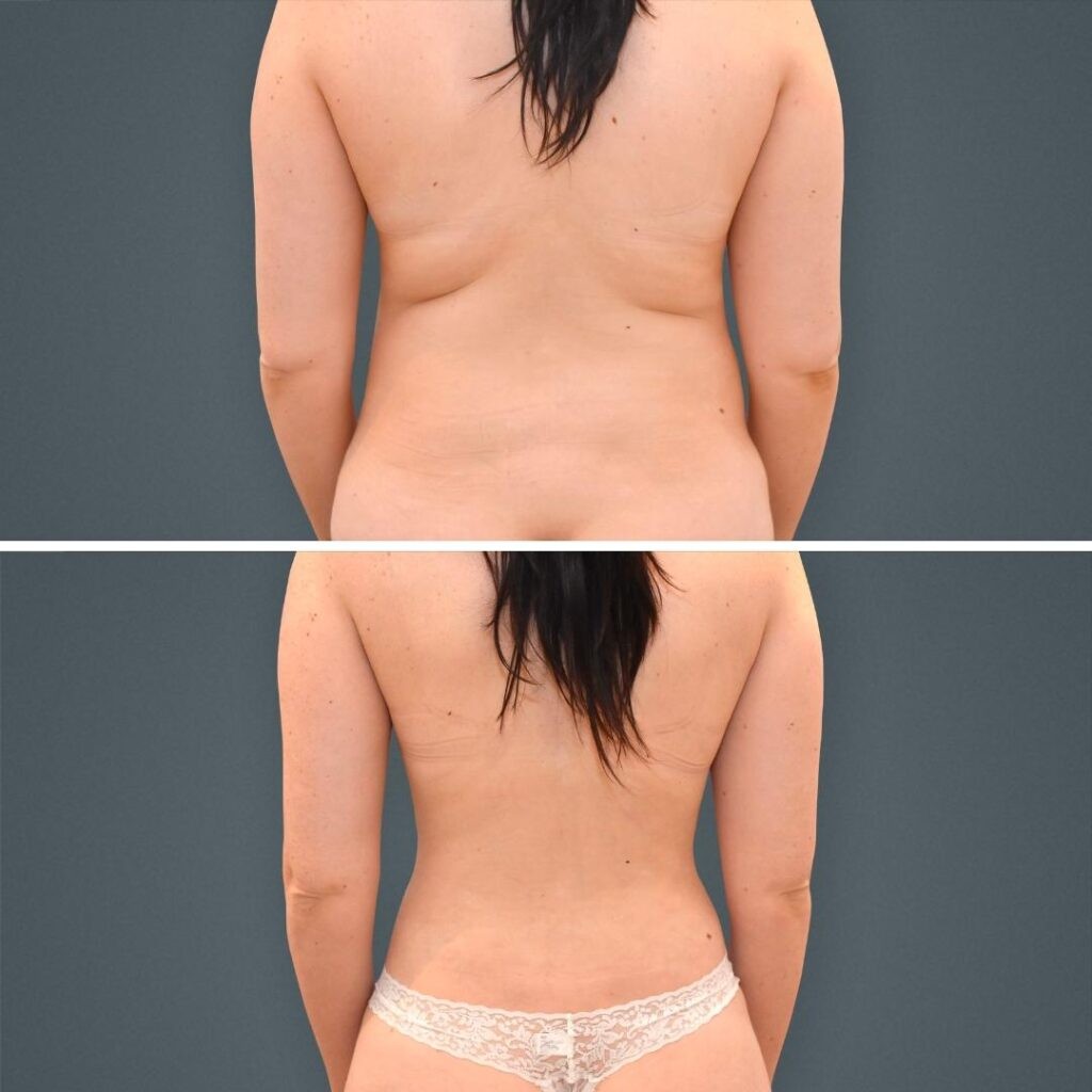 Goldcoast Liposuction Lovehandles Female 2023 Rear 176 Before And After