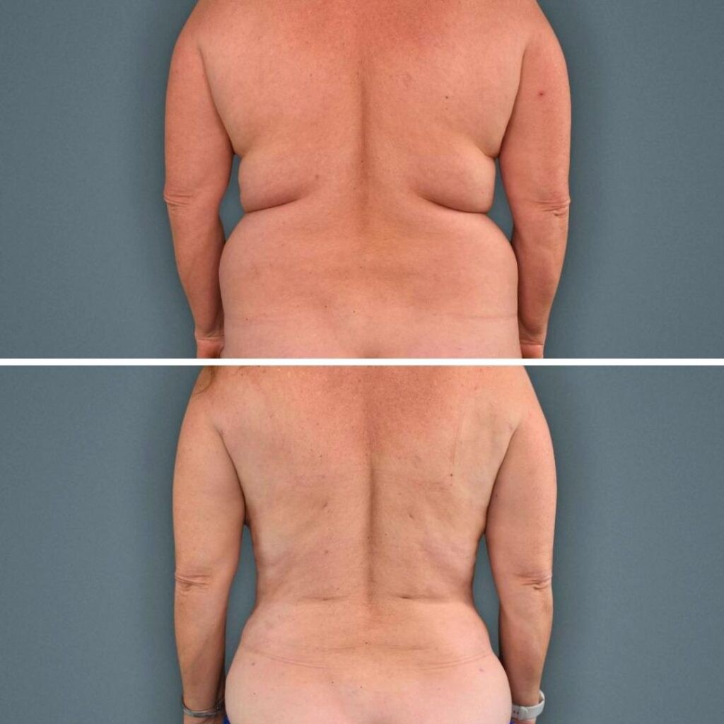 Goldcoast Liposuction Lovehandles Female 2023 Rear 178 Before And After