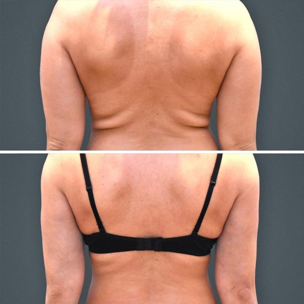 Goldcoast Liposuction Lovehandles Female 2023 Rear 189 Before And After