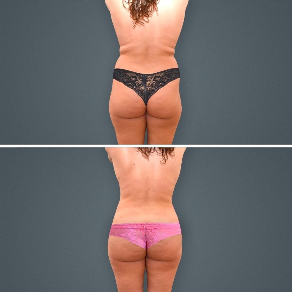 Goldcoast Liposuction Lovehandles Female 2023 Rear 197 Before And After