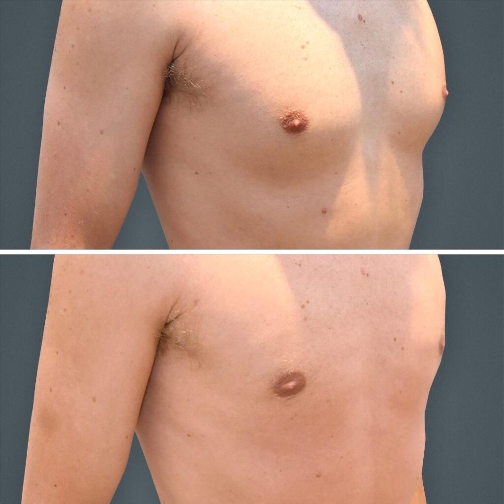Goldcoast Liposuction Manboobs Male 2023 Left 167 Before And After