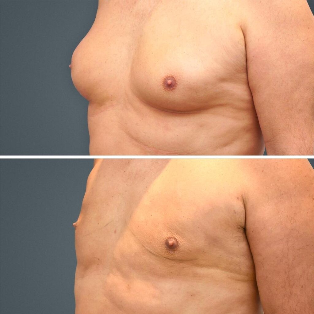 Goldcoast Liposuction Manboobs Male 2023 Right 148 Before And After