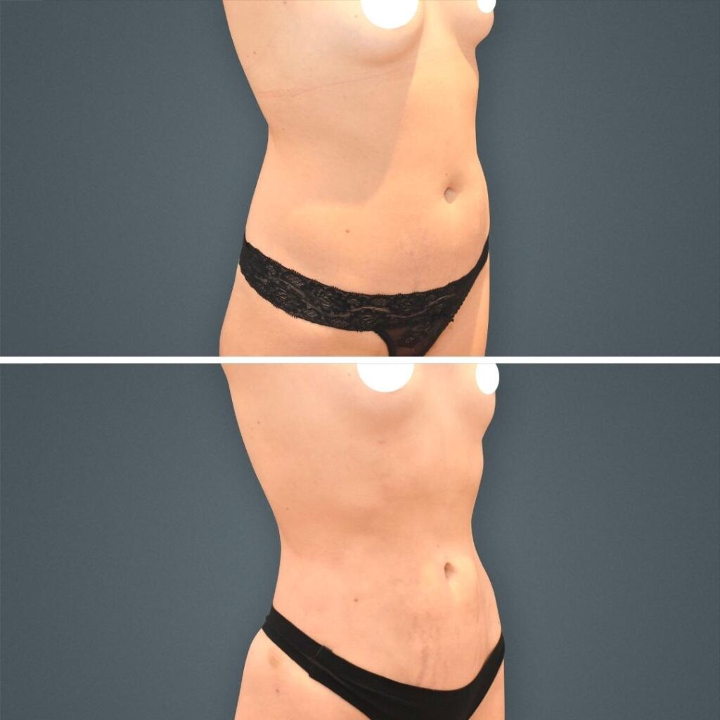Goldcoast Liposuction Stomach Female 2023 Left 196 Before And After