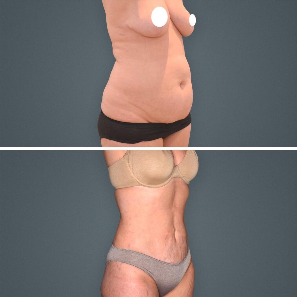 Goldcoast Liposuction Stomach Female 2023 Left 202 Before And After