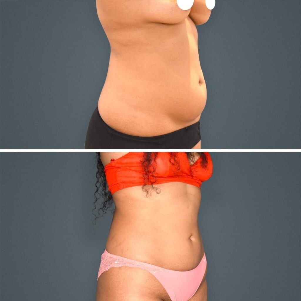 Goldcoast Liposuction Stomach Female 2023 Left 204 Before And After