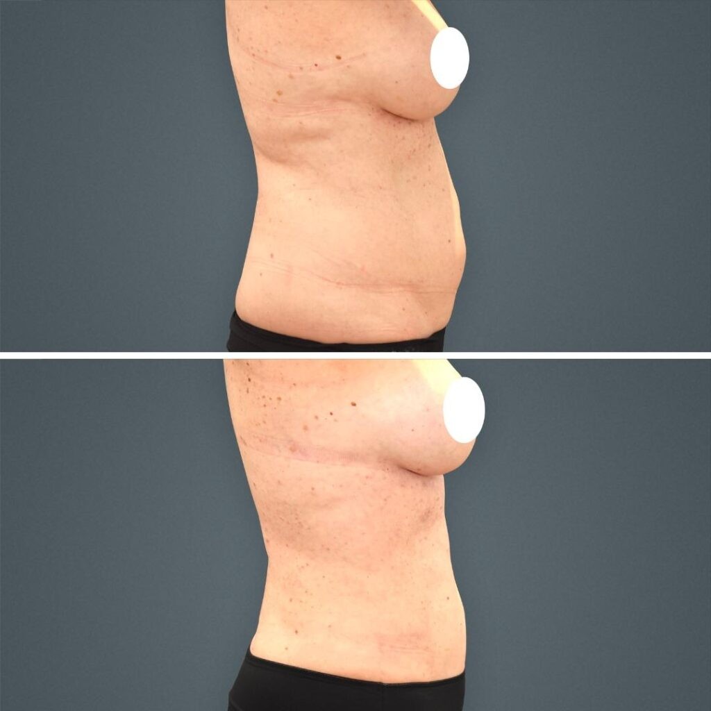 Goldcoast Liposuction Stomach Female 2023 Left 207 Before And After