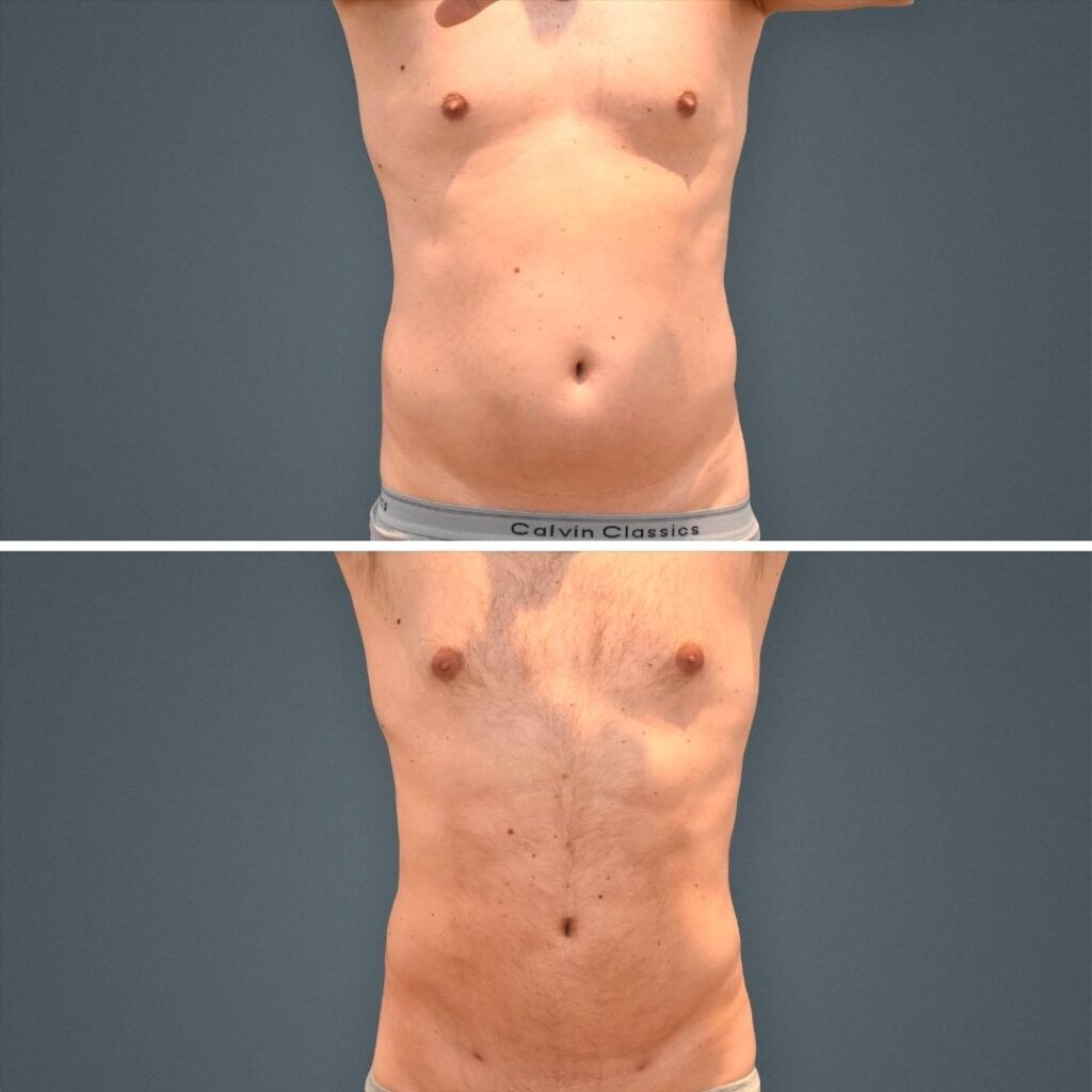 Goldcoast Liposuction Stomach Male 2023 Front 205 Before And After
