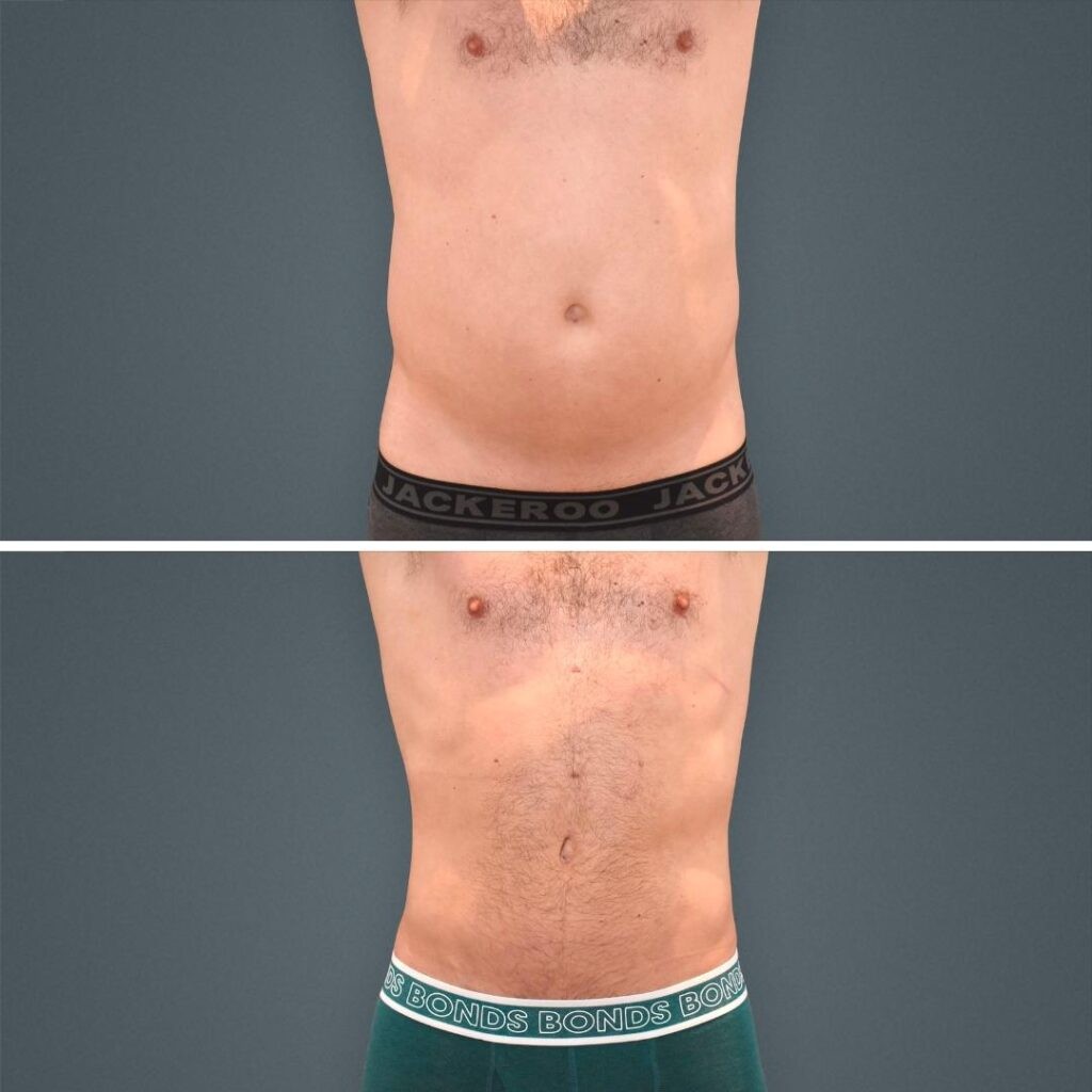 Goldcoast Liposuction Stomach Male 2023 Front 206 Before And After