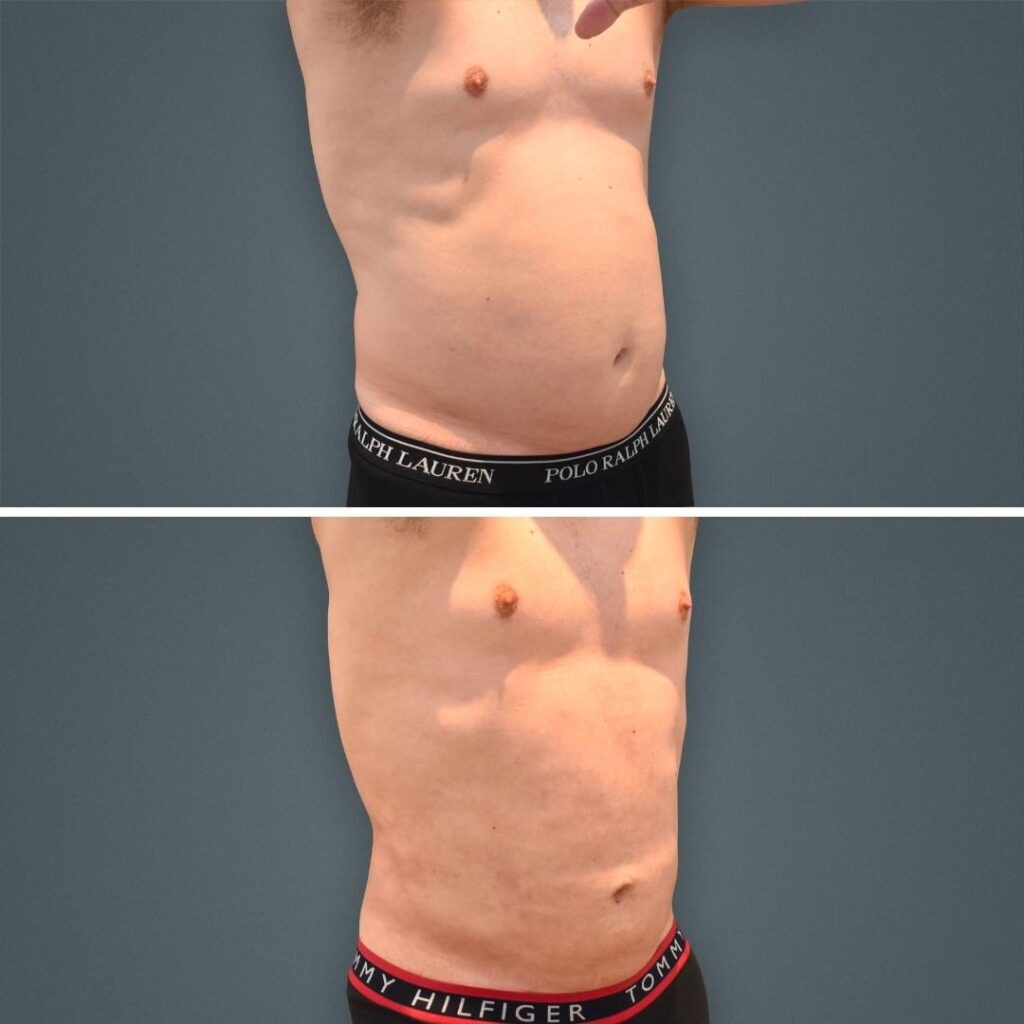 Goldcoast Liposuction Stomach Male 2023 Left 159 Before And After