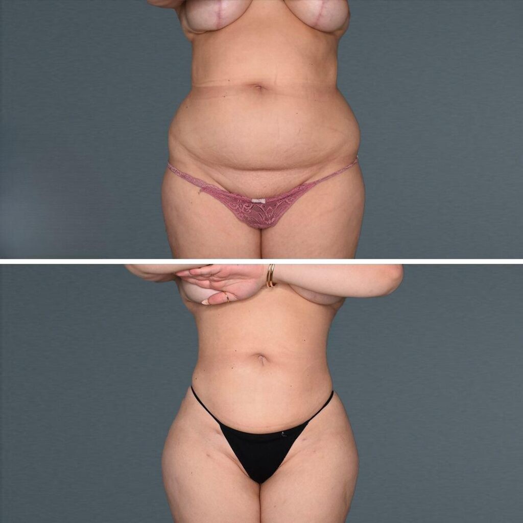 Goldcoast Megaliposuction Stomach Female 2022 Front 62 Before And After