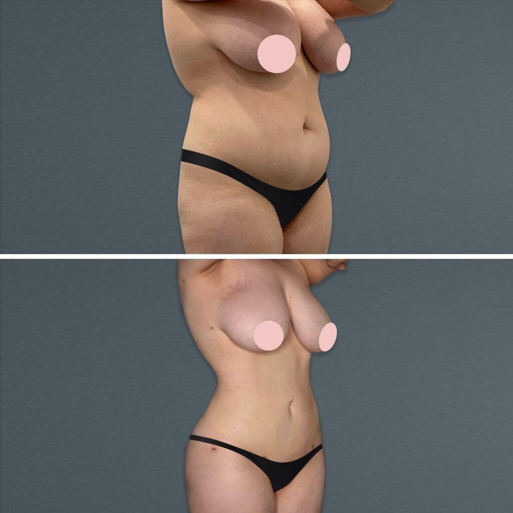 Goldcoast Megaliposuction Stomach Female 2022 Left 70 Before And After