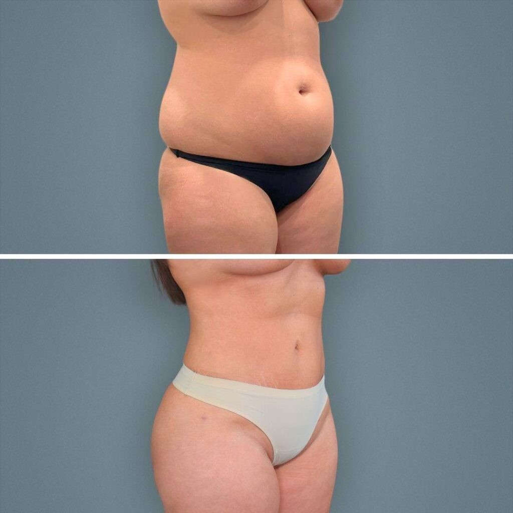 Goldcoast Megaliposuction Stomach Female 2022 Left 85 Before And After