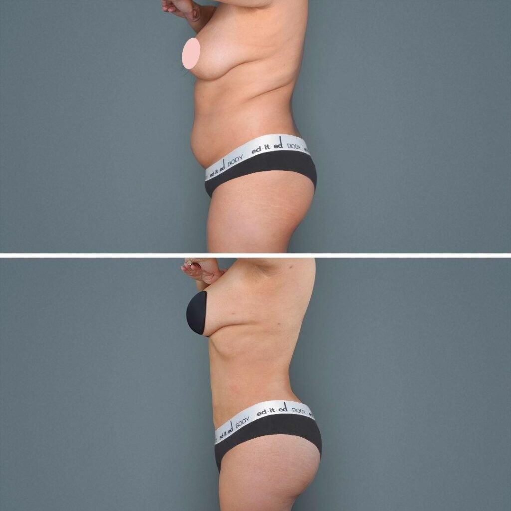 Goldcoast Megaliposuction Stomach Female 2022 Right 79 Before And After