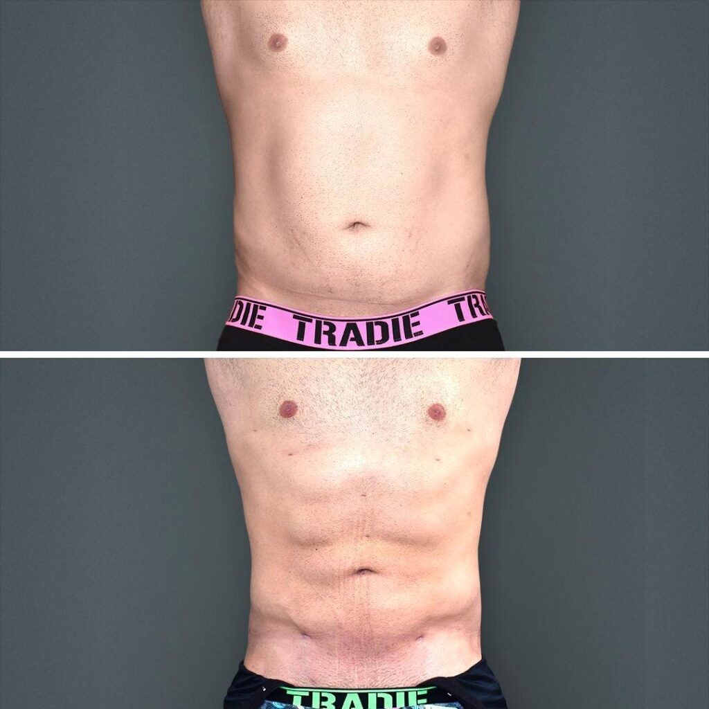 Goldcoast Vaserliposuction Stomach Male 2023 Front 120 Before And After