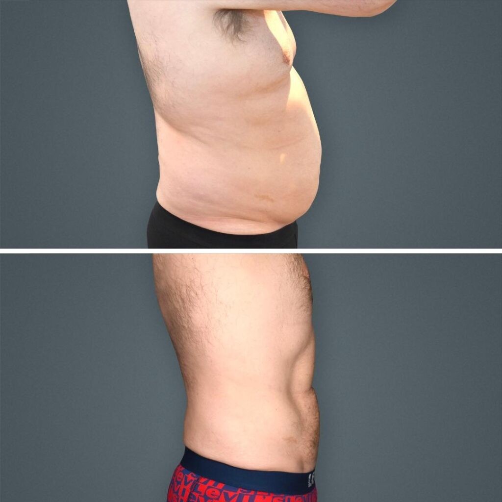 Goldcoast Vaserliposuction Stomach Male 2023 Left 195 Before And After