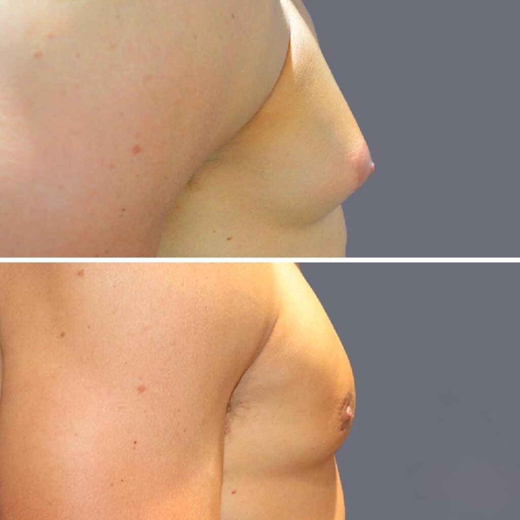 Vaser Liposuction before and after