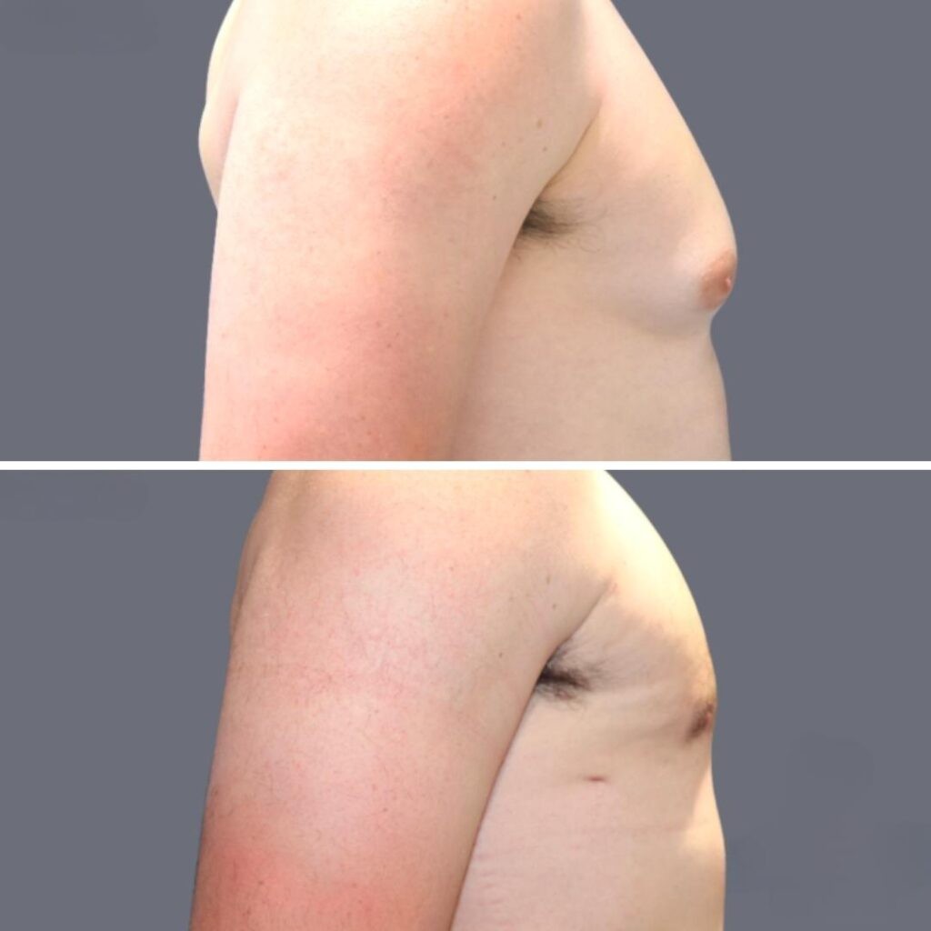 Vaser Liposuction before and after