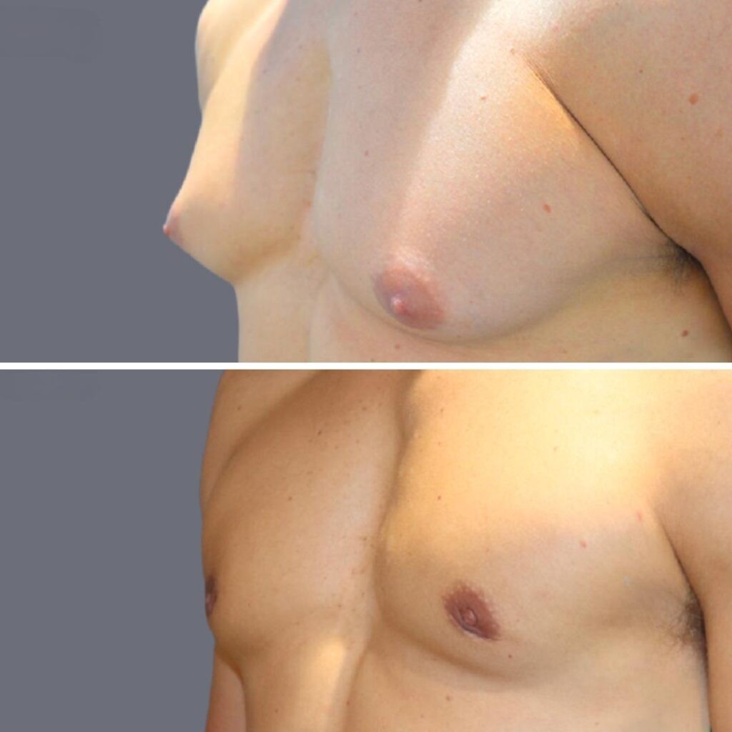 Vaser Liposuction before and after