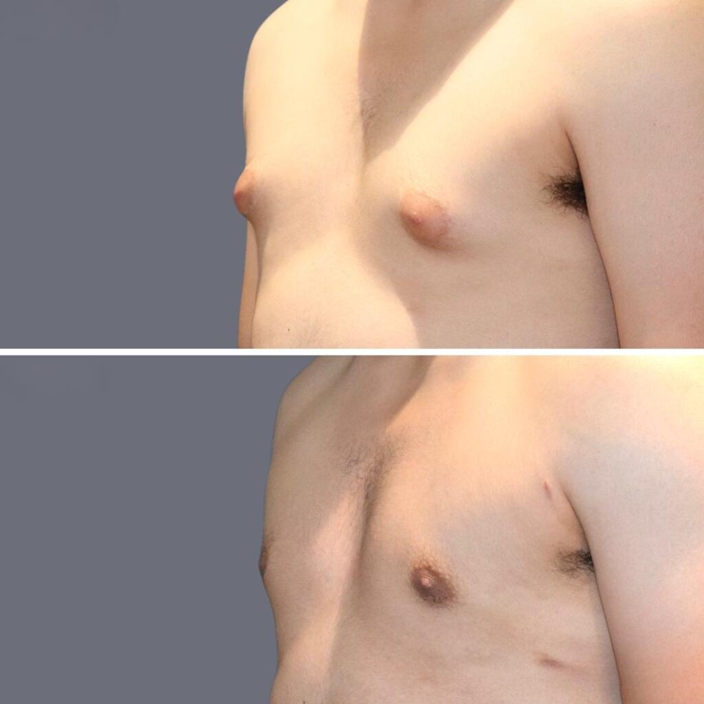 Gynecomastia Pre2024 004 Before And After