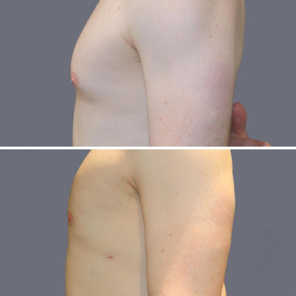 Gynecomastia Pre2024 005 Before And After