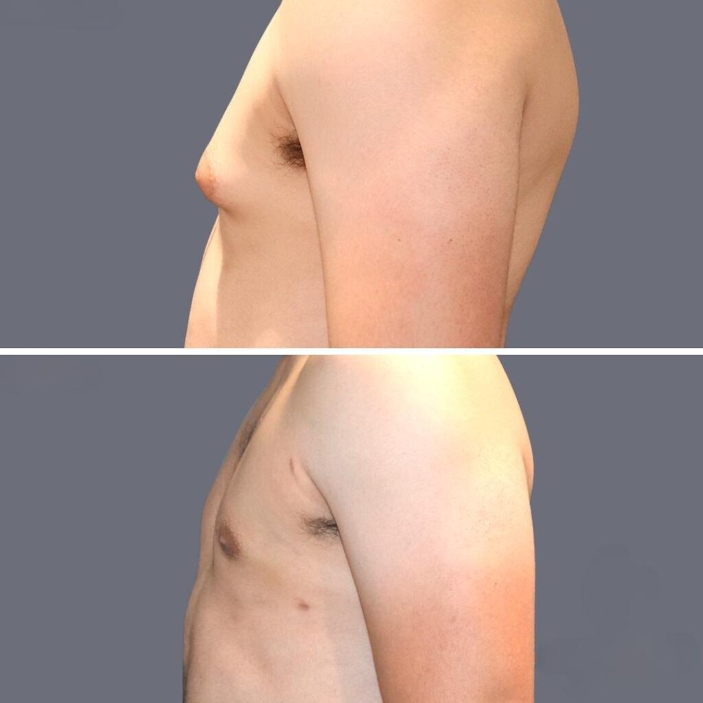 Gynecomastia Pre2024 008 Before And After