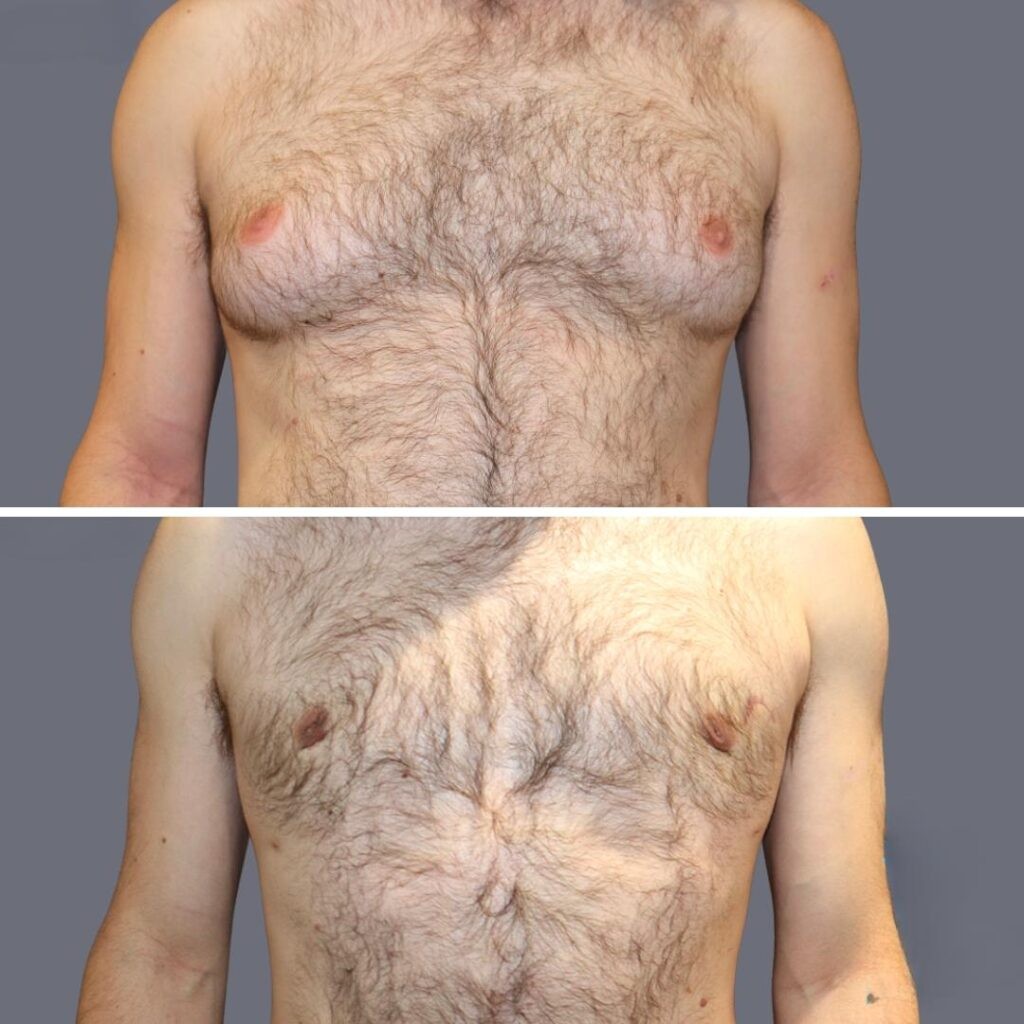 Gynecomastia Pre2024 009 Before And After