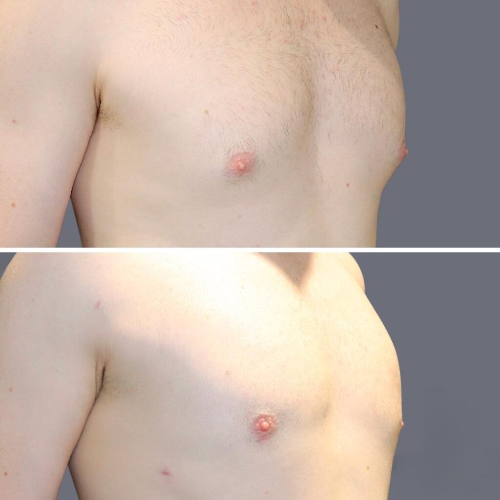 Gynecomastia Pre2024 010 Before And After