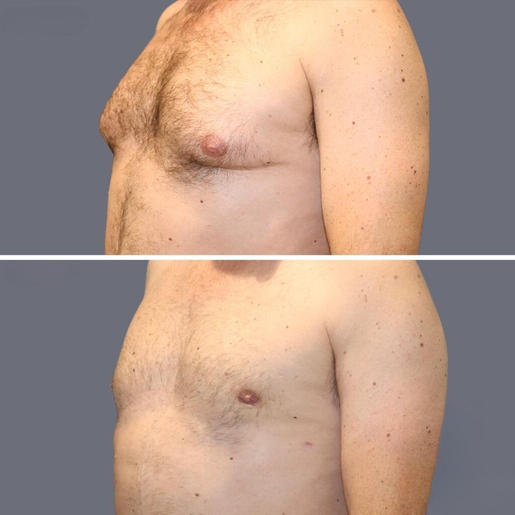 Gynecomastia Pre2024 011 Before And After