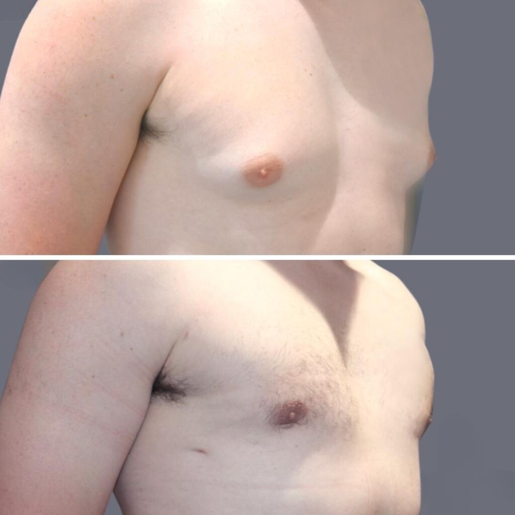 Gynecomastia Pre2024 012 Before And After
