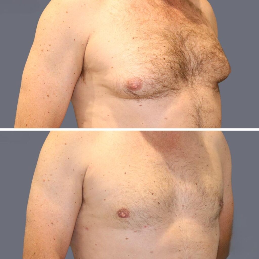 Gynecomastia Pre2024 013 Before And After