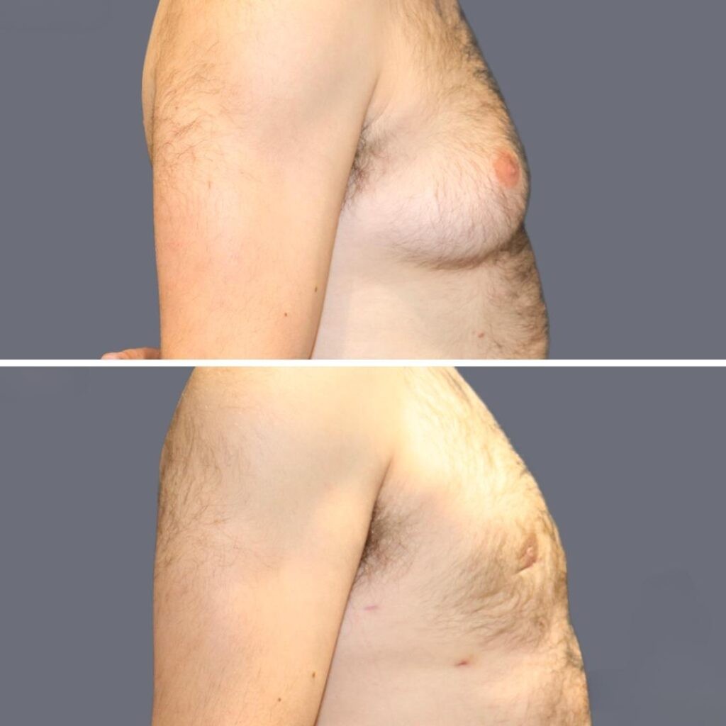Gynecomastia Pre2024 014 Before And After