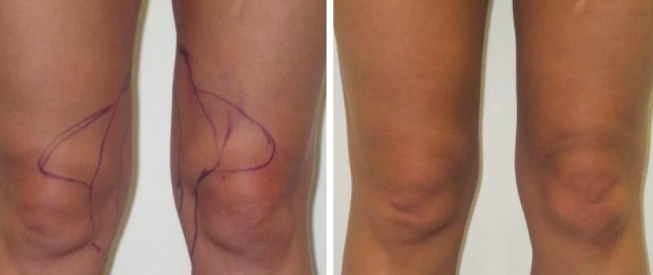 Knee Liposuction Female Pre2024 014 Before And After