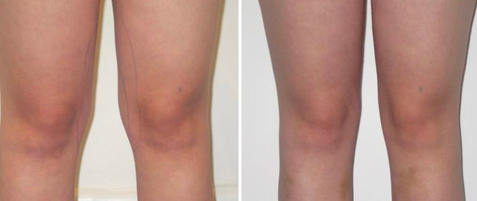 Knee Liposuction Female Pre2024 015 Before And After