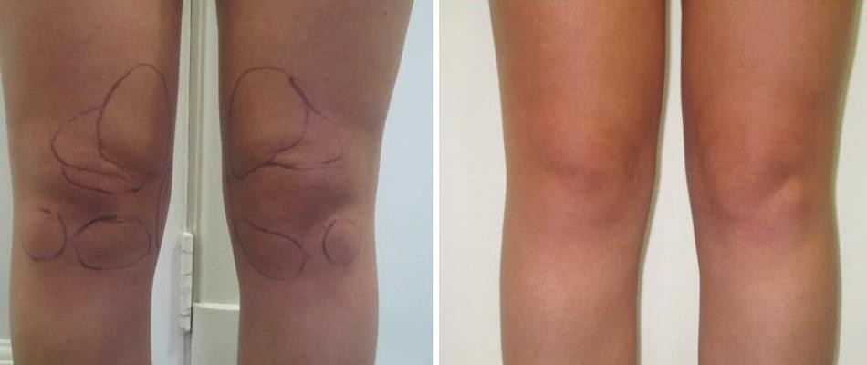 Knee Liposuction Female Pre2024 016 Before And After