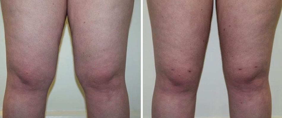 Knee Liposuction Female Pre2024 017 Before And After