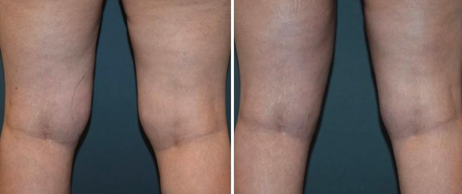 Knee Thighs Liposuction Female Pre2024 019 Before And After