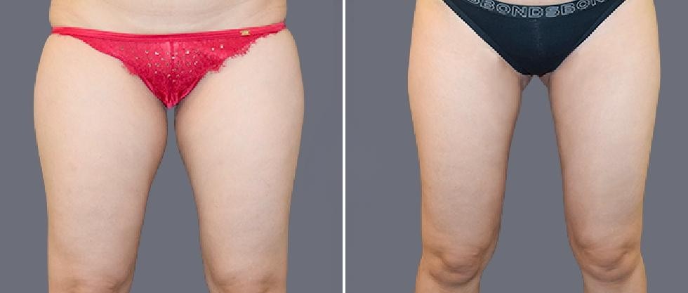 Leg Vaser Pre2024 001 Before And After