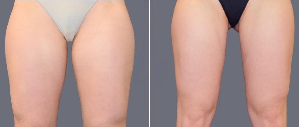 Leg Vaser Pre2024 002 Before And After