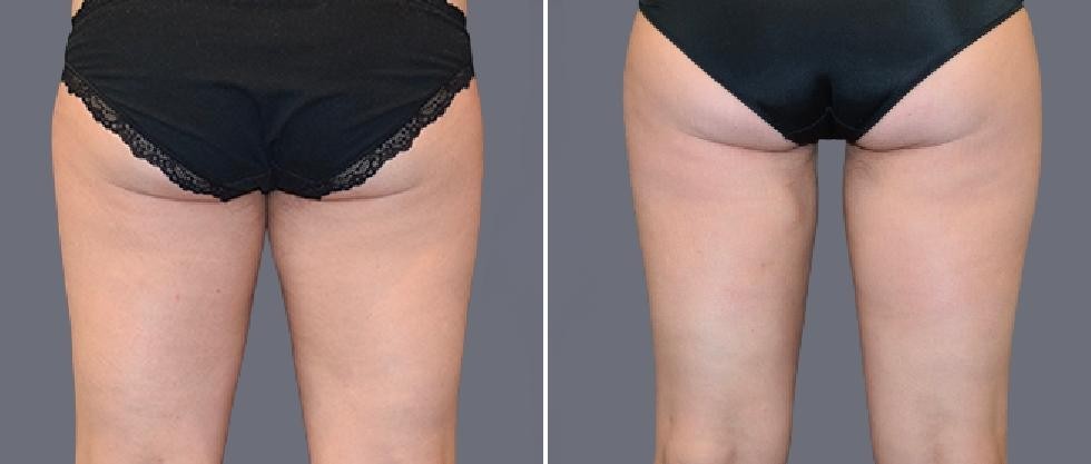 Leg Vaser Pre2024 003 Before And After
