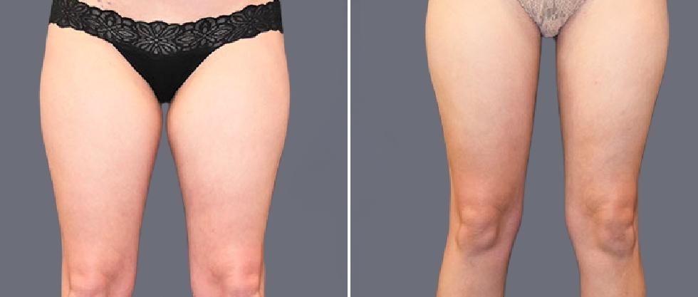 Leg Vaser Pre2024 004 Before And After